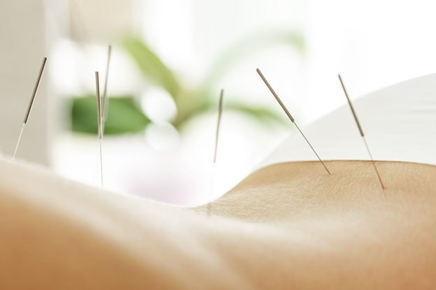 So, What Is Acupuncture